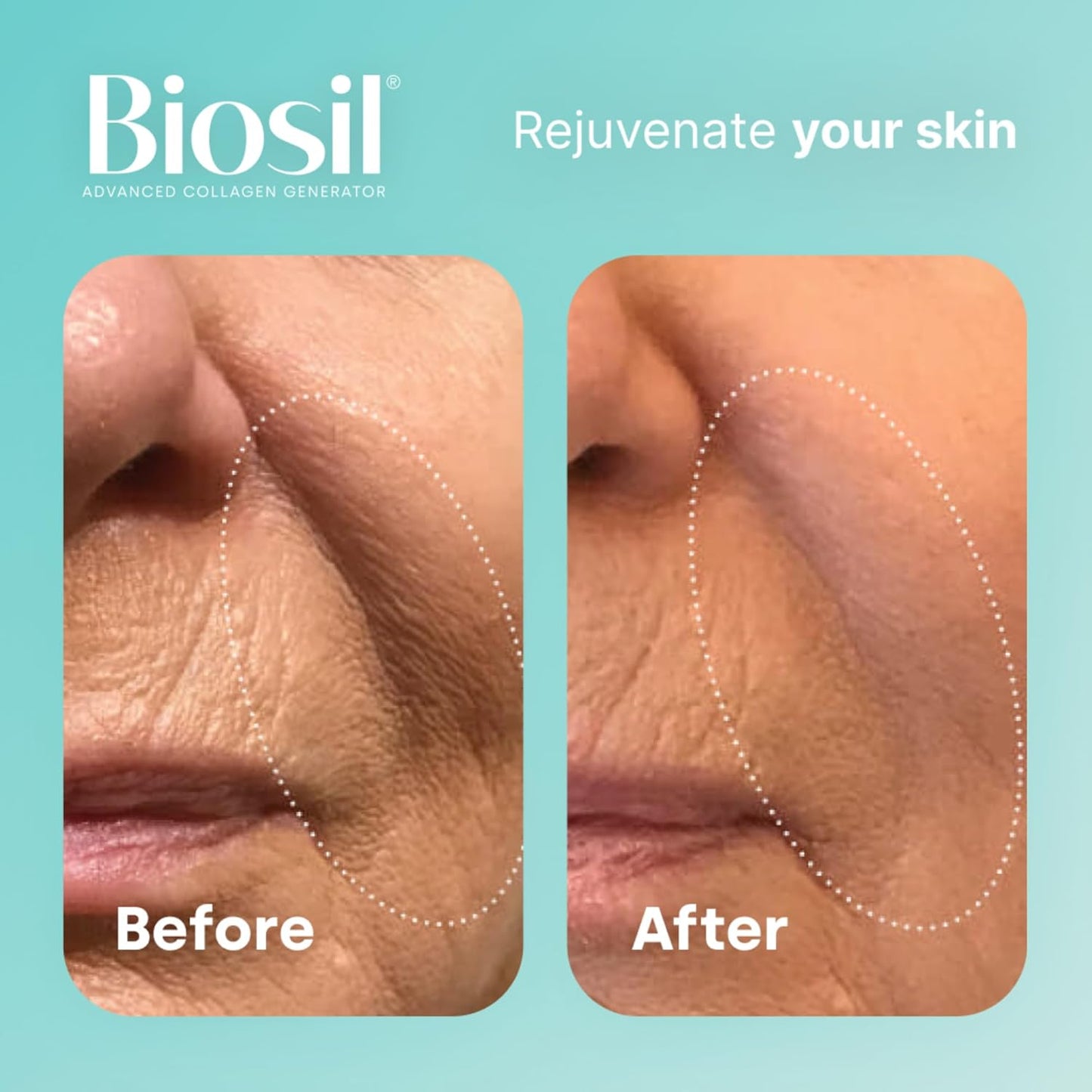 120 Original Capsules of Biosil Collagen Generator with Patented ch-OSA Complex for Generating and Protecting Your Own Collagen - Non-GMO Formula - 60-Day Supply