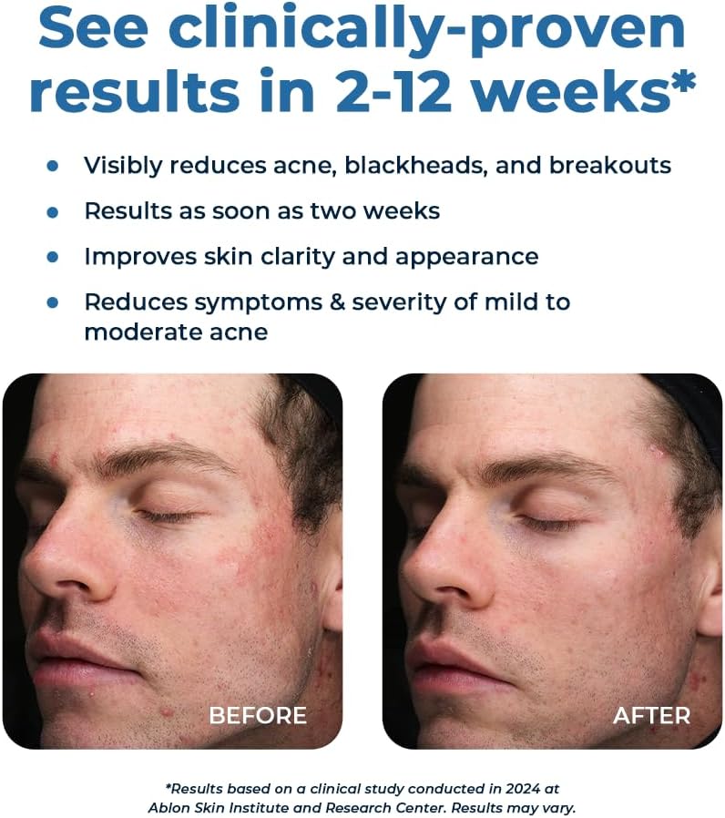 Acne Clearing Supplement with Vitamins A, C, E, and Zinc | Breakout Treatment for Men and Women | Skin Health Formula with Selenium and Chromium | 2 Pack