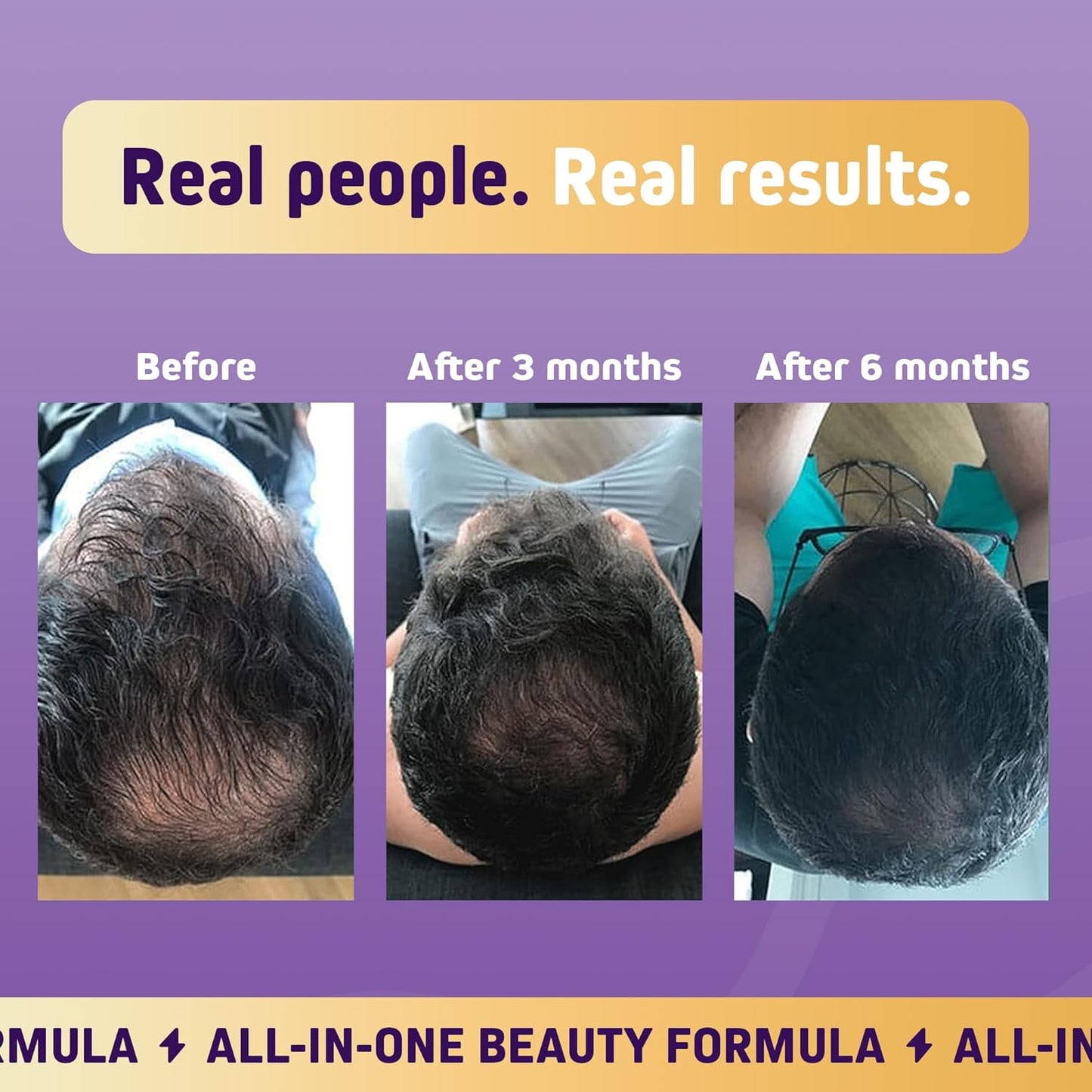 Herbtonics Foli Gummies - Biotin Hair Growth Supplement for Women & Men - Skin, Nails Vitamins - 60 Sugarfree Gummies