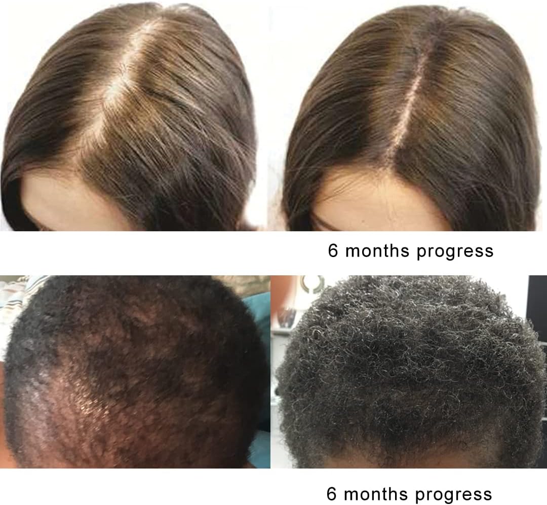 Organic Saw Palmetto Oil with Beta Sitosterol for Prostate Health & Hair Loss - DHT Blocker & Sleep Aid (30-Day Supply)