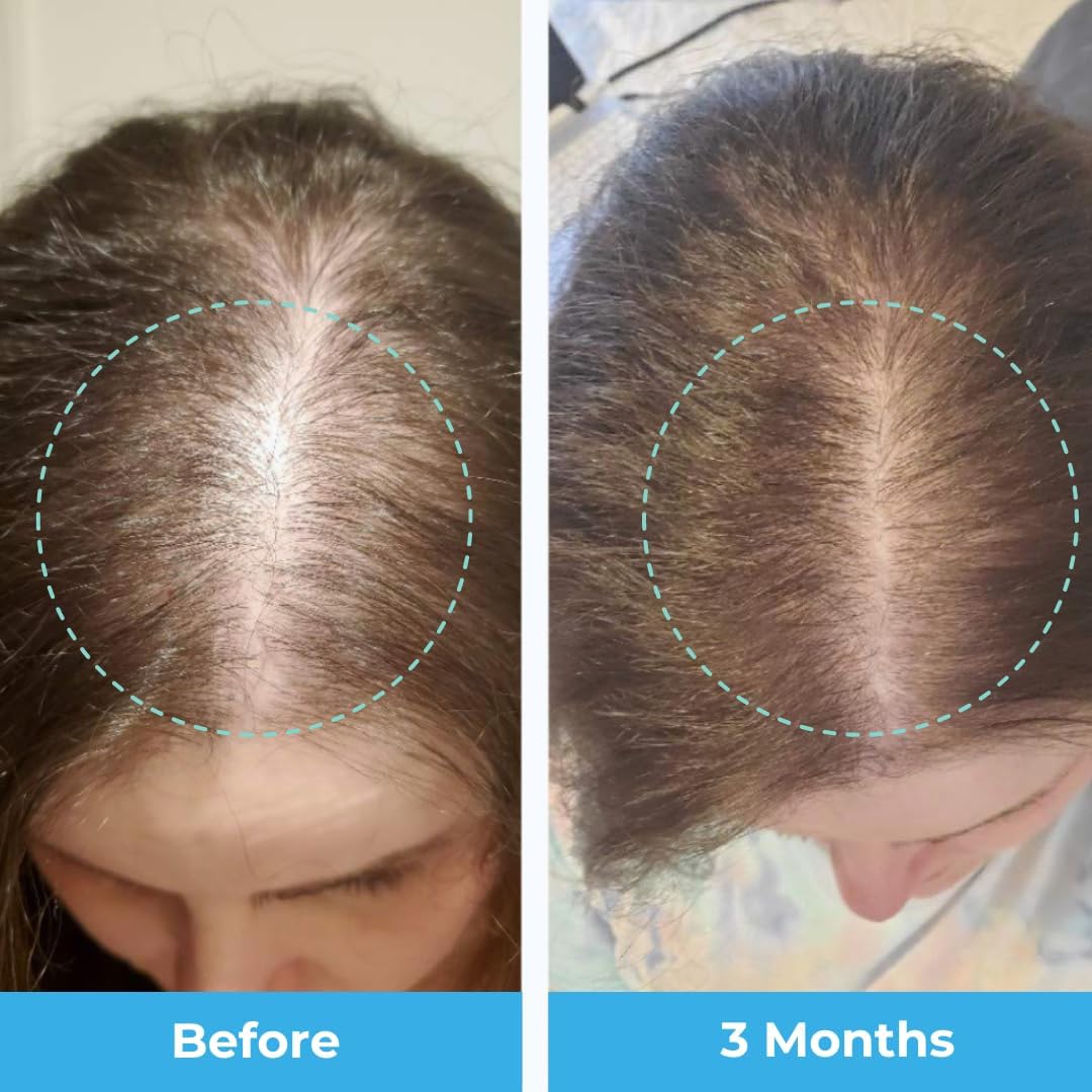 Passion Fruit Gummies for Postpartum Hair Loss with Biotin, Collagen, & Folate - Baby Blues Hair Vitamins