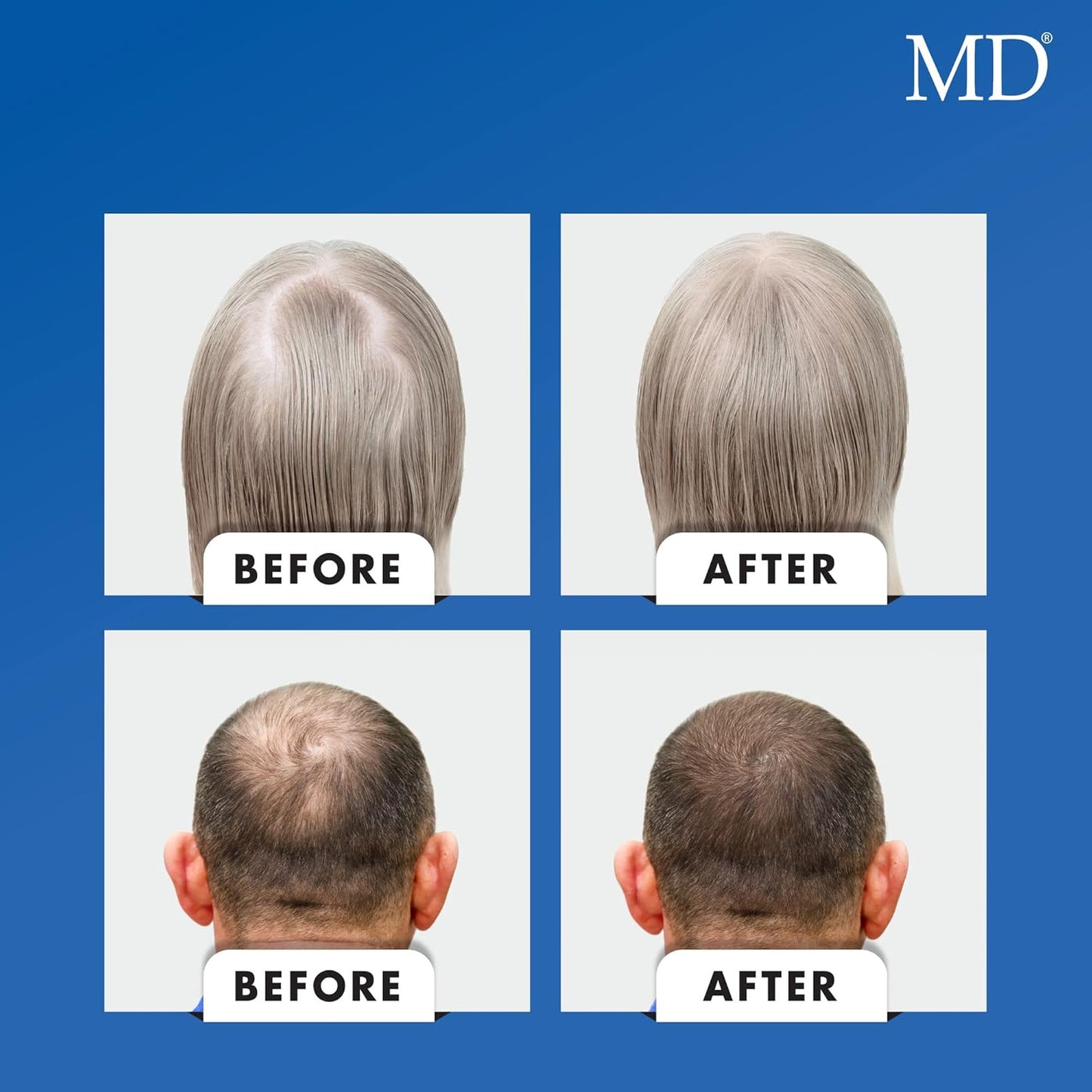 MD Nutri Biotin Hair Growth Supplement - 30 Capsules for Hair Loss, Shedding & Thinning - Promotes Longer, Thicker Hair - Reduce Breakage & Improve Hair Health