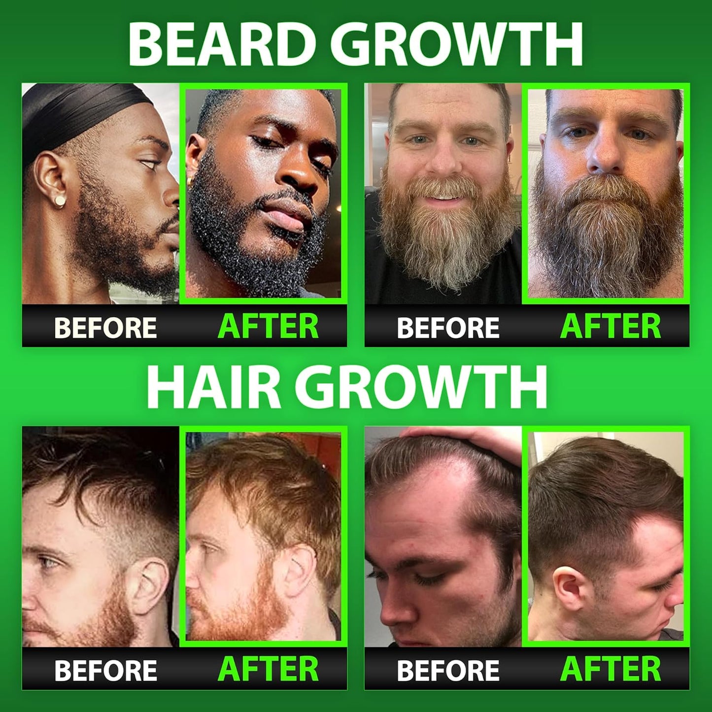 Men's Beard Growth Kit: Liquid Biotin Supplement, Collagen Peptides, 620,000mcg Biotin Gummies - Hair Growth Vitamins